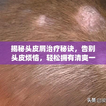 揭秘头皮屑治疗秘诀，告别头皮烦恼，轻松拥有清爽一夏！