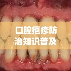 口腔疱疹防治知识普及，了解症状与应对方法！