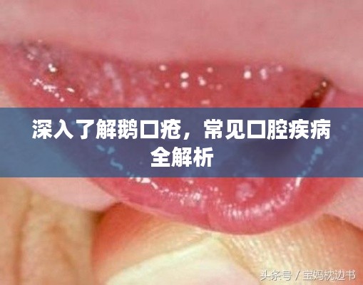 深入了解鹅口疮,常见口腔疾病全解析