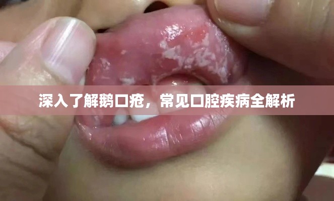 深入了解鹅口疮,常见口腔疾病全解析